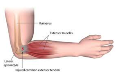 Who suffers from tennis elbow (Lateral epicondylitis)?